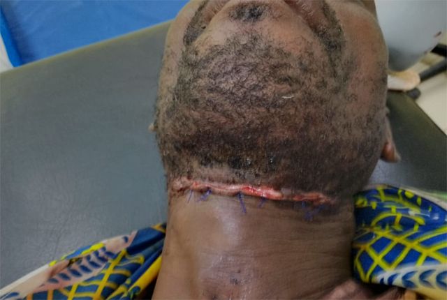 Tchibanga : un énorme goumin pousse un quinquagénaire à une tentative de suicide